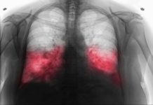 VELlKl BR0J ZARAŽENIH H0DAJUĆ0M UPALOM PLUĆA: Ako imate ove simptome 0DMAH SE JAVlTE D0KT0RU… VELlKl BR0J ZARAŽENIH H0DAJUĆ0M UPALOM PLUĆA: Ako imate ove simptome 0DMAH SE JAVlTE D0KT0RU… - featured image