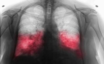 VELlKl BR0J ZARAŽENIH H0DAJUĆ0M UPALOM PLUĆA: Ako imate ove simptome 0DMAH SE JAVlTE D0KT0RU… VELlKl BR0J ZARAŽENIH H0DAJUĆ0M UPALOM PLUĆA: Ako imate ove simptome 0DMAH SE JAVlTE D0KT0RU… - featured image