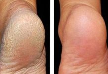 ZA MEKA STOPALA POTREBNA SU VAM SAMO 3 SASTOJKA IZ KUHINJE: Potopite noge u ovu smjesu na 15 minuta i recite zbogom ispucalim petama ZA MEKA STOPALA POTREBNA SU VAM SAMO 3 SASTOJKA IZ KUHINJE: Potopite noge u ovu smjesu na 15 minuta i recite zbogom ispucalim petama - featured image