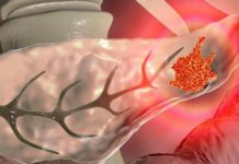 Nekoliko simptoma ukazuje na rak gušterače: Ako ih osjetite, nemojte ih ignorirati! Nekoliko simptoma ukazuje na rak gušterače: Ako ih osjetite, nemojte ih ignorirati! - featured image