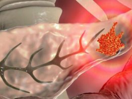 Nekoliko simptoma ukazuje na rak gušterače: Ako ih osjetite, nemojte ih ignorirati! Nekoliko simptoma ukazuje na rak gušterače: Ako ih osjetite, nemojte ih ignorirati! - featured image