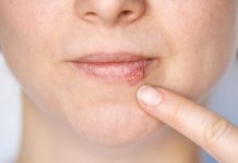 Kada herpes prestaje biti zarazan? Evo što trebate znati Kada herpes prestaje biti zarazan? Evo što trebate znati - featured image