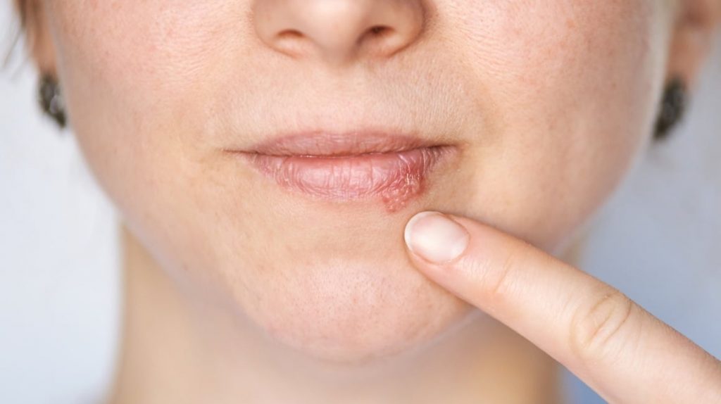 Kada herpes prestaje biti zarazan? Evo što trebate znati - featured image Kada herpes prestaje biti zarazan? Evo što trebate znati - featured image