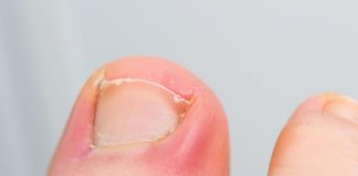 PAZITE SE! Ako nokti pokažu ovaj znak, idite odmah kod ljekara: Upozorenje na PROBLEM koje može biti OZBILJAN PAZITE SE! Ako nokti pokažu ovaj znak, idite odmah kod ljekara: Upozorenje na PROBLEM koje može biti OZBILJAN - featured image