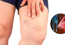 Simptomi krvnih ugrušaka u tijelu: Ako to primijetite, odmah potražite medicinsku pomoć Simptomi krvnih ugrušaka u tijelu: Ako to primijetite, odmah potražite medicinsku pomoć - featured image