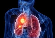 RASTE BROJ ZARAŽENIH HODAJUĆOM UPALOM PLUĆA: Ako imate ove simptome treba da se odmah javite ljekaru RASTE BROJ ZARAŽENIH HODAJUĆOM UPALOM PLUĆA: Ako imate ove simptome treba da se odmah javite ljekaru - featured image