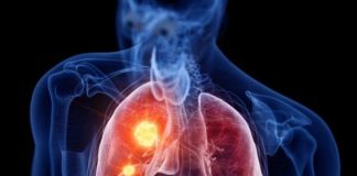 RASTE BROJ ZARAŽENIH HODAJUĆOM UPALOM PLUĆA: Ako imate ove simptome treba da se odmah javite ljekaru RASTE BROJ ZARAŽENIH HODAJUĆOM UPALOM PLUĆA: Ako imate ove simptome treba da se odmah javite ljekaru - featured image