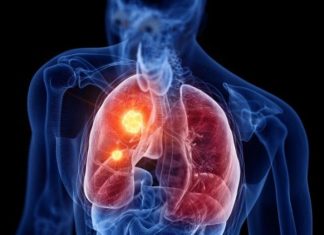 RASTE BROJ ZARAŽENIH HODAJUĆOM UPALOM PLUĆA: Ako imate ove simptome treba da se odmah javite ljekaru RASTE BROJ ZARAŽENIH HODAJUĆOM UPALOM PLUĆA: Ako imate ove simptome treba da se odmah javite ljekaru - featured image