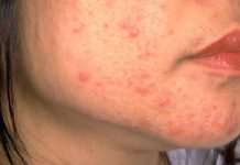 OPREZ! RODITELJI, OBRATITE PAŽNJU NA OVO! Ove navike mogu spasiti kožu vaše djece od akni, VAŽNO JE DA POČNETE ODMAH OPREZ! RODITELJI, OBRATITE PAŽNJU NA OVO! Ove navike mogu spasiti kožu vaše djece od akni, VAŽNO JE DA POČNETE ODMAH - featured image