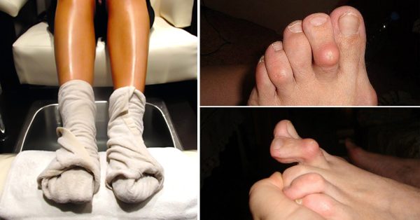 Mnogi se kunu u ovaj prirodni pristup – domaće rešenje koje ublažava tegobe artritisa! - featured image Mnogi se kunu u ovaj prirodni pristup – domaće rešenje koje ublažava tegobe artritisa! - featured image