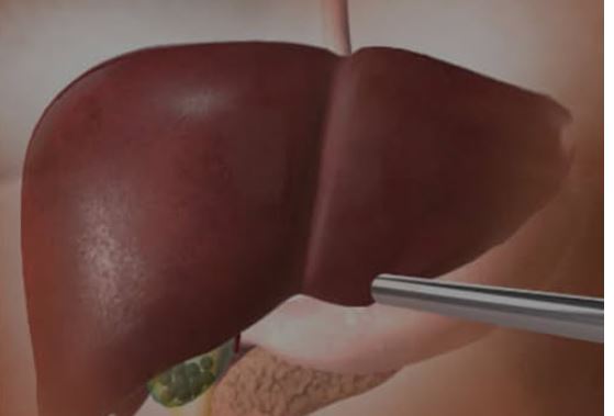 OVA HRANA UNIŠTAVA JETRU SKORO ISTO KOLIKO I ALKOHOL: 5 namirnica čiji unos morate ograničiti - featured image OVA HRANA UNIŠTAVA JETRU SKORO ISTO KOLIKO I ALKOHOL: 5 namirnica čiji unos morate ograničiti - featured image