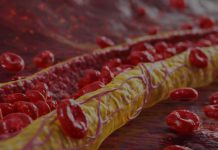 Ovi znaci na nogama pokazuju da imate izuzetno visok holesterol: Ne smijete ih ignorisati, posljedice su fatalne po tijelo Ovi znaci na nogama pokazuju da imate izuzetno visok holesterol: Ne smijete ih ignorisati, posljedice su fatalne po tijelo - featured image