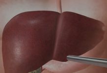 Jetra pod pritiskom: namirnice koje je opterećuju gotovo kao alkohol Jetra pod pritiskom: namirnice koje je opterećuju gotovo kao alkohol - featured image