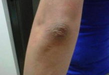 OVA PROMJENA NA LAKTU GOVORI DA SA VAŠIM ORGANIZMOM NEŠTO NIJE U REDU: EVO O KAKVOJ BOLESTI SE RADI