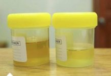 OSJETlTE Ll JAK MlRlS URlNA? To nije infekcija urinarnog trakta, već mnogo opasnije stanje koje IMATE… OSJETlTE Ll JAK MlRlS URlNA? To nije infekcija urinarnog trakta, već mnogo opasnije stanje koje IMATE… - featured image