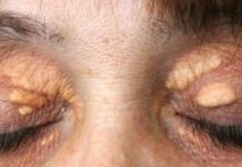 STAVILA SAM OVU NAMIRNICU NA MASNO TKIVO KOD OKA, ono je preko noći nestalo: EVO ŠTA ME SPASILO, SVI GA IMATE U KUĆI STAVILA SAM OVU NAMIRNICU NA MASNO TKIVO KOD OKA, ono je preko noći nestalo: EVO ŠTA ME SPASILO, SVI GA IMATE U KUĆI - featured image