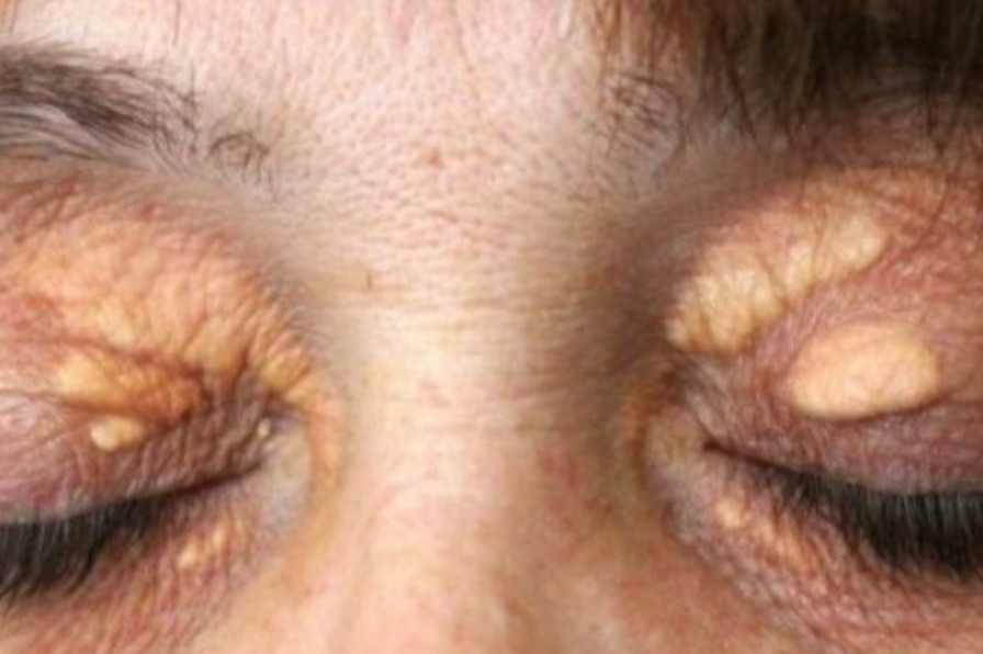 STAVILA SAM OVU NAMIRNICU NA MASNO TKIVO KOD OKA, ono je preko noći nestalo: EVO ŠTA ME SPASILO, SVI GA IMATE U KUĆI - featured image STAVILA SAM OVU NAMIRNICU NA MASNO TKIVO KOD OKA, ono je preko noći nestalo: EVO ŠTA ME SPASILO, SVI GA IMATE U KUĆI - featured image