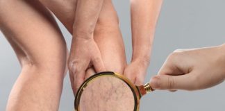 Zašto Su Vam Vene Odjednom Vidljivije? Uzroci, Savjeti i Kada Potražiti Pomoć Zašto Su Vam Vene Odjednom Vidljivije? Uzroci, Savjeti i Kada Potražiti Pomoć - featured image