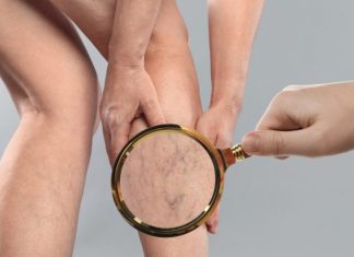 Zašto Su Vam Vene Odjednom Vidljivije? Uzroci, Savjeti i Kada Potražiti Pomoć Zašto Su Vam Vene Odjednom Vidljivije? Uzroci, Savjeti i Kada Potražiti Pomoć - featured image