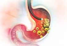 5 ranih simptoma raka želuca: Tumor može da raste godinama, a svi pacijenti prvo osjete ovo 5 ranih simptoma raka želuca: Tumor može da raste godinama, a svi pacijenti prvo osjete ovo - featured image