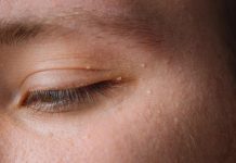 Uklanjaju se jednstavno, TREBAJU VAM 3 SASTOJKA KOJA IMATE U KUĆI – NI SLUČAJNO IH NE ISTISKUJTE,AKO IMATE OVE BIJELE TAČKICE NA LICU! Uklanjaju se jednstavno, TREBAJU VAM 3 SASTOJKA KOJA IMATE U KUĆI – NI SLUČAJNO IH NE ISTISKUJTE,AKO IMATE OVE BIJELE TAČKICE NA LICU! - featured image