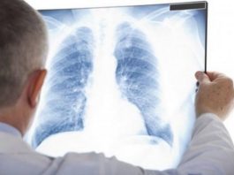 9 SIMPTOMA RAKA PLUĆA NA KOJE TRABATE ODMAH REAGOVATI: Ovako vas tijelo upozorava na ovu bolest! 9 SIMPTOMA RAKA PLUĆA NA KOJE TRABATE ODMAH REAGOVATI: Ovako vas tijelo upozorava na ovu bolest! - featured image