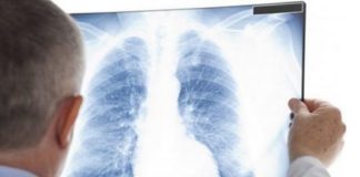 9 SIMPTOMA RAKA PLUĆA NA KOJE TRABATE ODMAH REAGOVATI: Ovako vas tijelo upozorava na ovu bolest! 9 SIMPTOMA RAKA PLUĆA NA KOJE TRABATE ODMAH REAGOVATI: Ovako vas tijelo upozorava na ovu bolest! - featured image