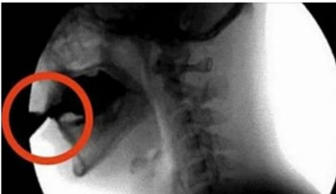 OVAJ OTROV UNIŠTAVA VAŠE KOSTI: Većina ga konzumira barem jednom dnevno - featured image OVAJ OTROV UNIŠTAVA VAŠE KOSTI: Većina ga konzumira barem jednom dnevno - featured image