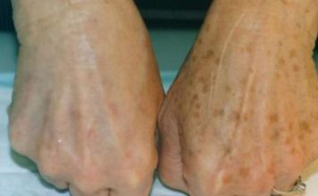 PRIMJETILI STE DA VAM SE POJAVLJUJU STARAČKE PJEGE : To je znak da imate ozbiljan problem sa jednim organom! PRIMJETILI STE DA VAM SE POJAVLJUJU STARAČKE PJEGE : To je znak da imate ozbiljan problem sa jednim organom! - featured image