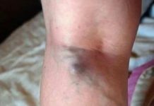 NAMIRNICE KOJE POVEĆAVAJU RIZIK OD TROMBOZE, JEDNA POSEBNO: Jedemo ih svakoga dana, a štete arterijama NAMIRNICE KOJE POVEĆAVAJU RIZIK OD TROMBOZE, JEDNA POSEBNO: Jedemo ih svakoga dana, a štete arterijama - featured image